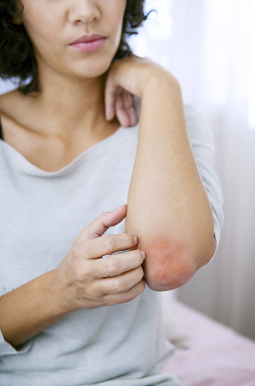 psoriasis-tratamiento