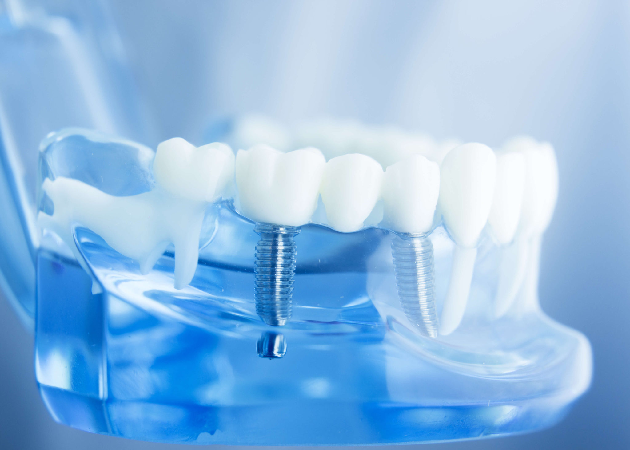implantologia-dental-valencia implantologia-dental-valencia
