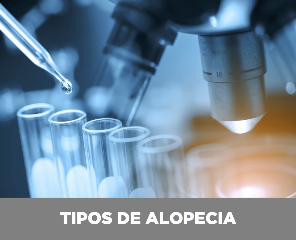 tipos-alopecia-valencia