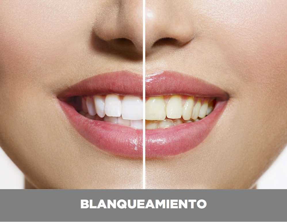 Blanqueamiento Blanqueamiento-dental