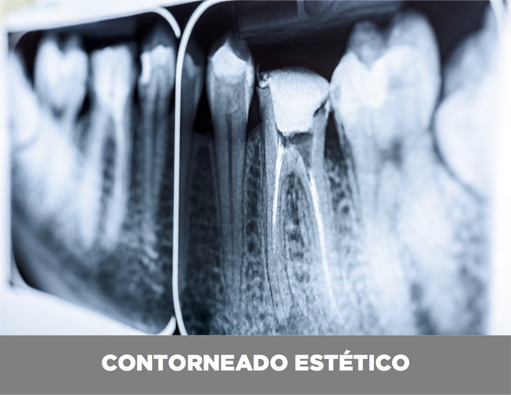 contorneado-estetico-valencia