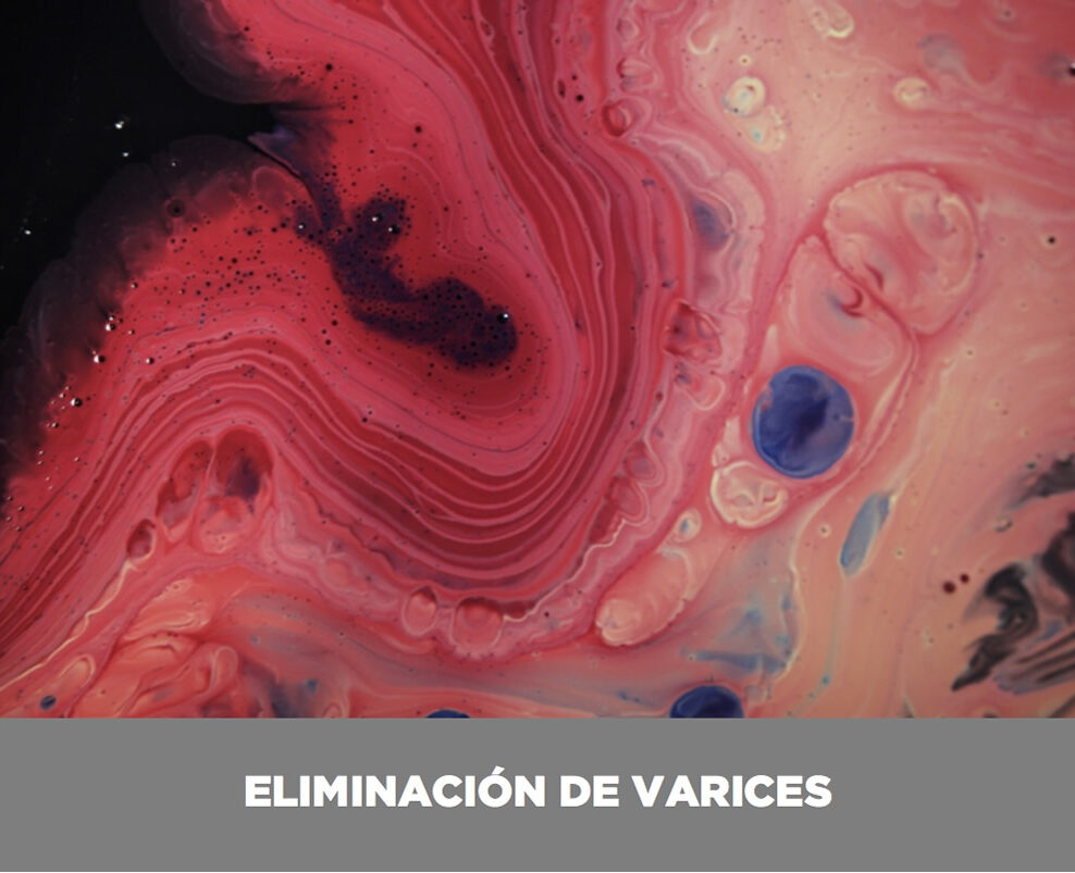 eliminacion-varices-valencia