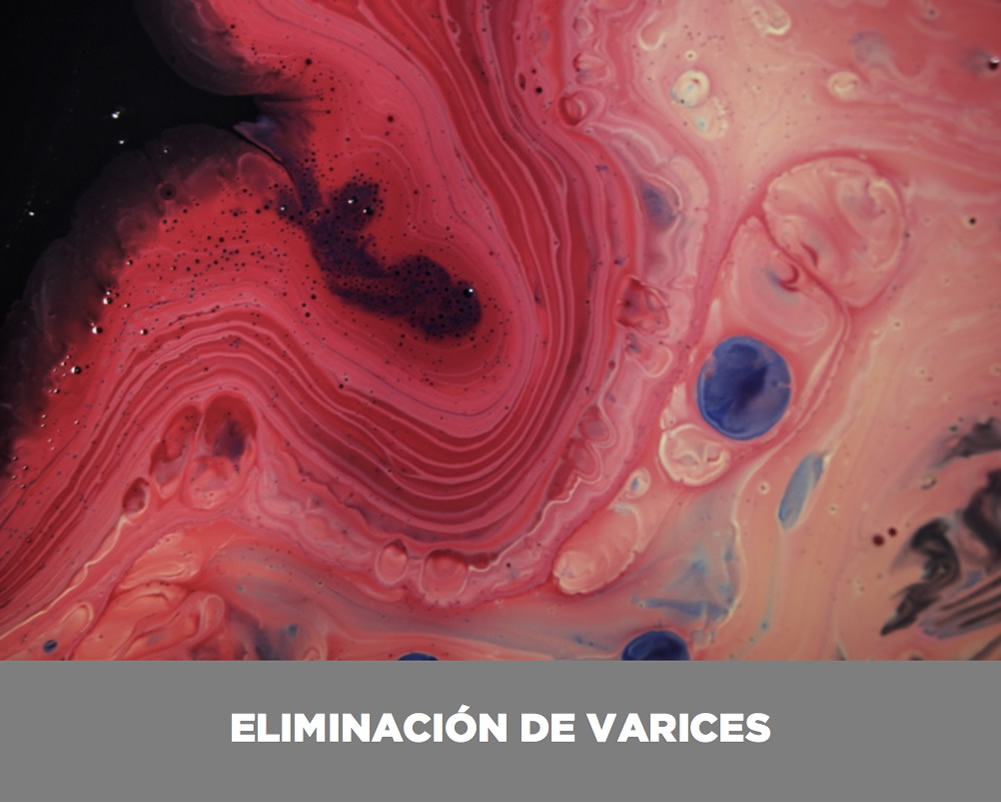 eliminacion-varices-valencia