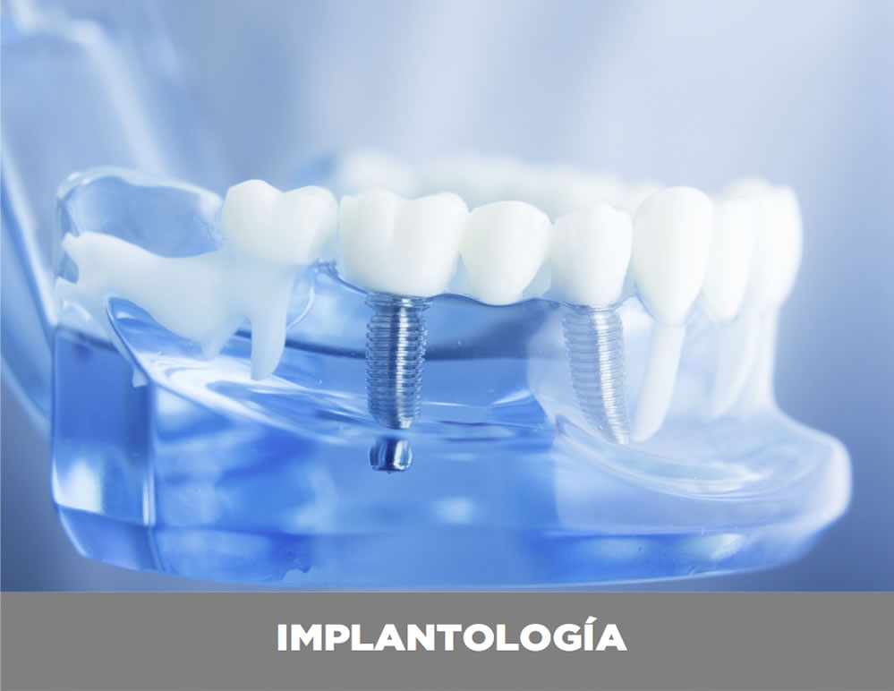 implantologia-valencia
