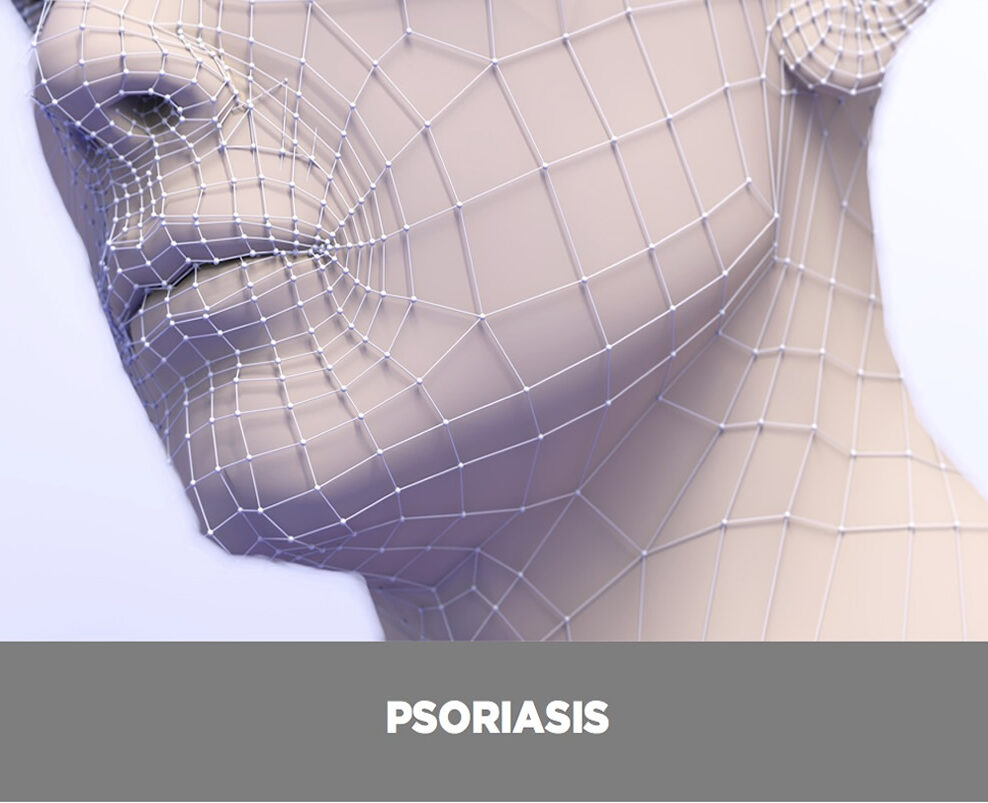 psoriasis-valencia