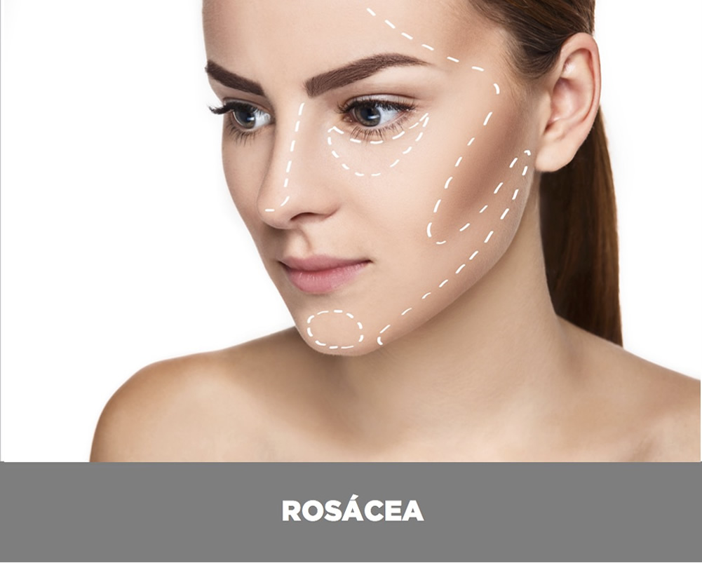 rosacea-valencia