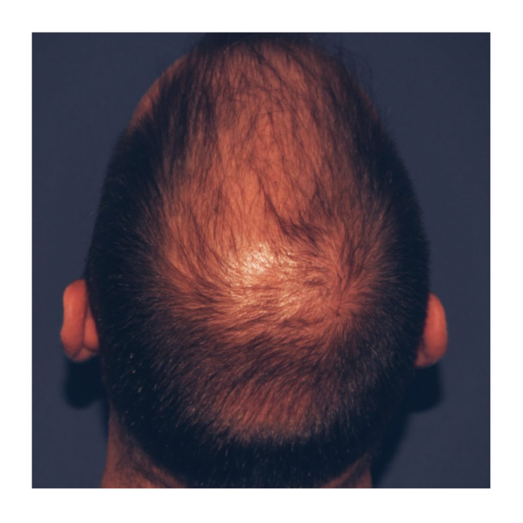 tipos alopecias