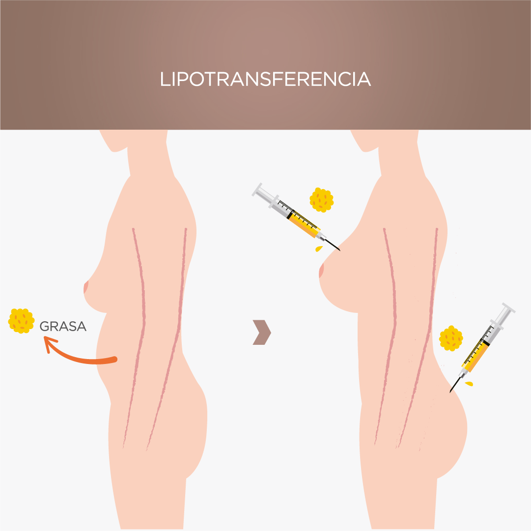 lipotransferencia-valencia