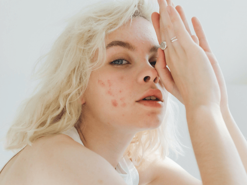 tratamiento acne valencia