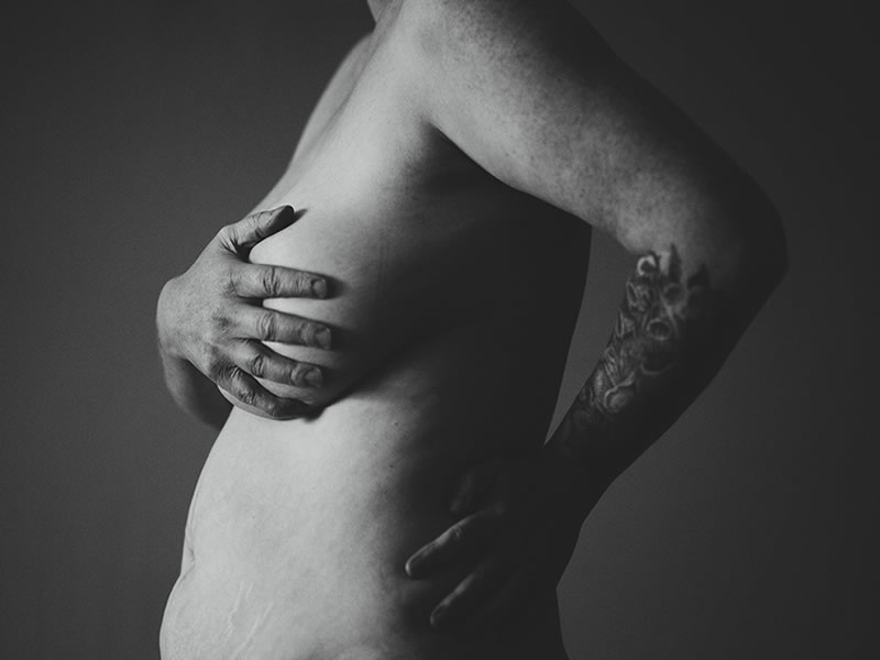 lipodistrofia abdominal gigante