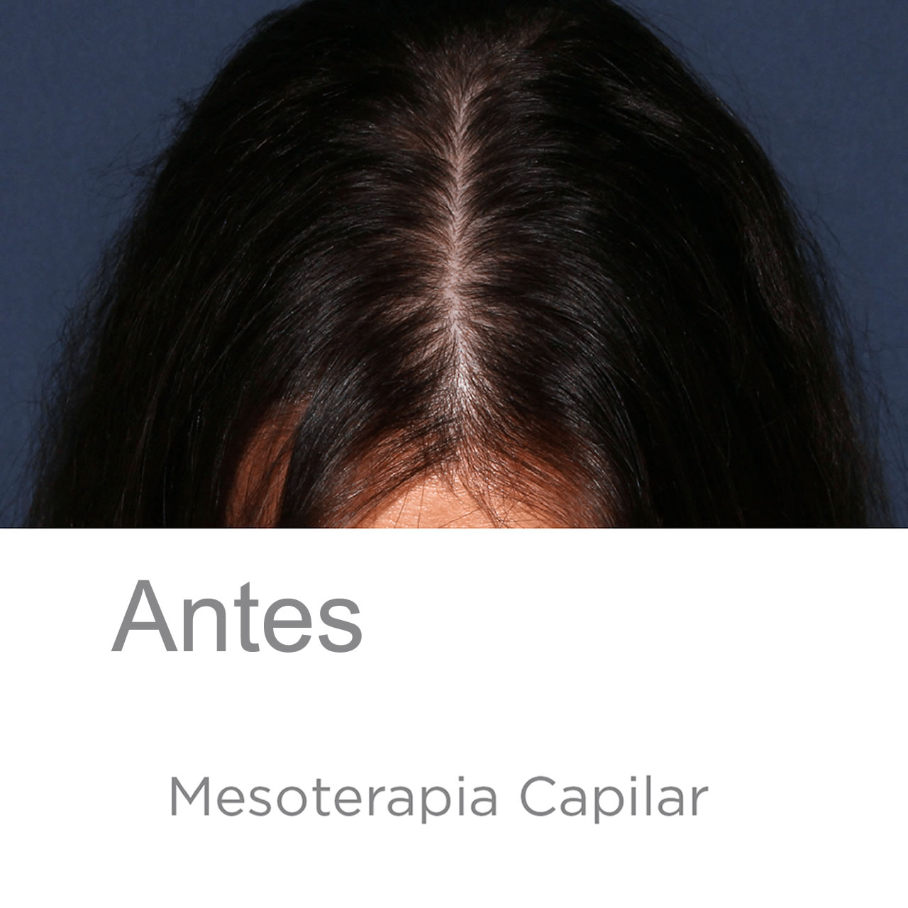 antes mesoterapia