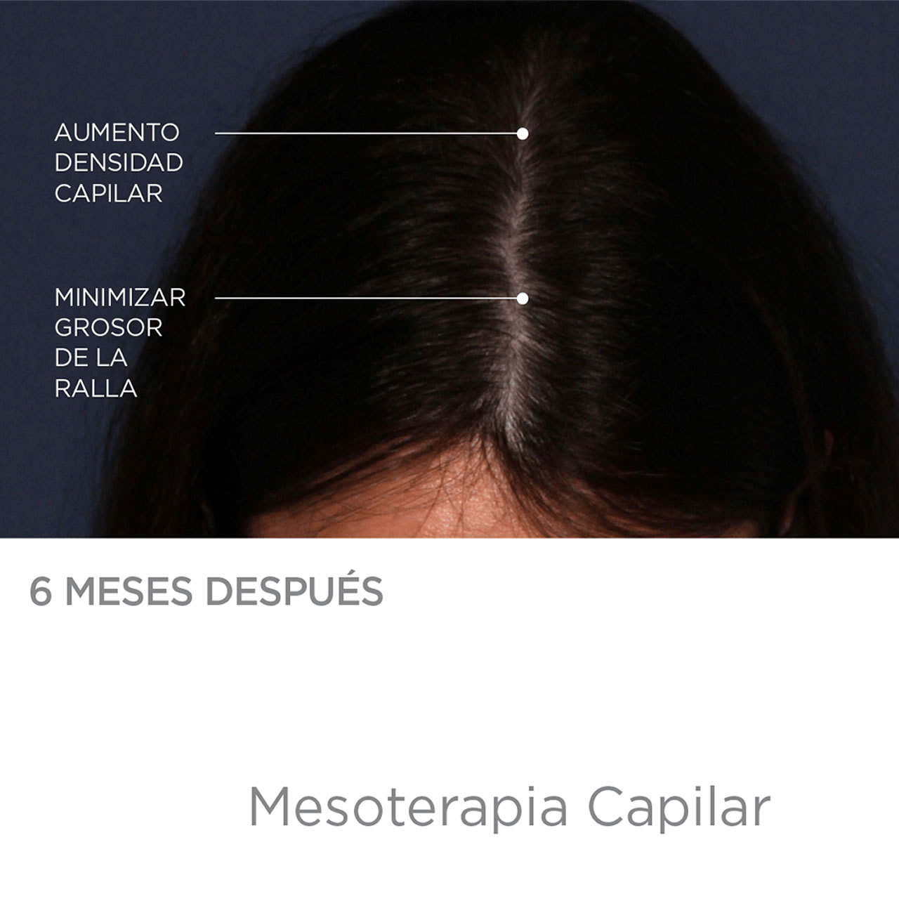 despues mesoterapia capilar