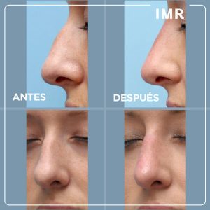 operacion nariz valencia