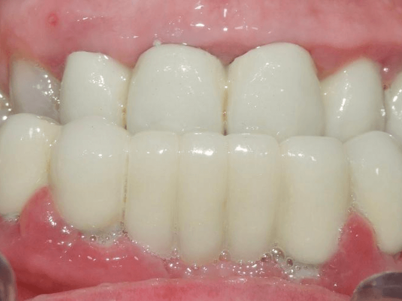 IMPLANTOLOGIA INMEDIATA VALENCIA ANTES