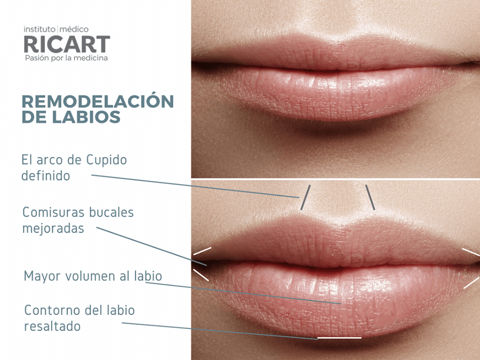 aumento labios valencia