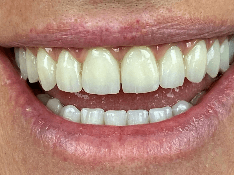 IMPLANTOLOGIA INMEDIATA VALENCIA DESPUES