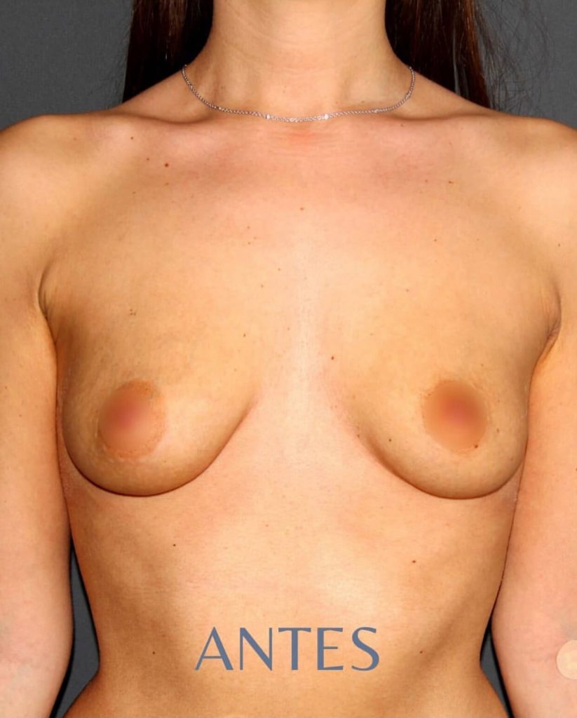 aumento-pechos-valencia