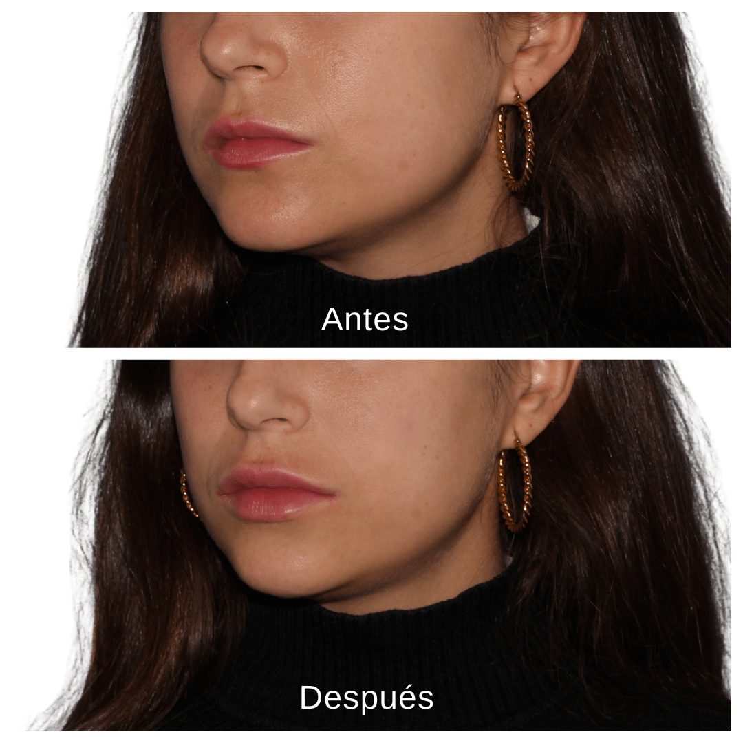 aumento labios valencia