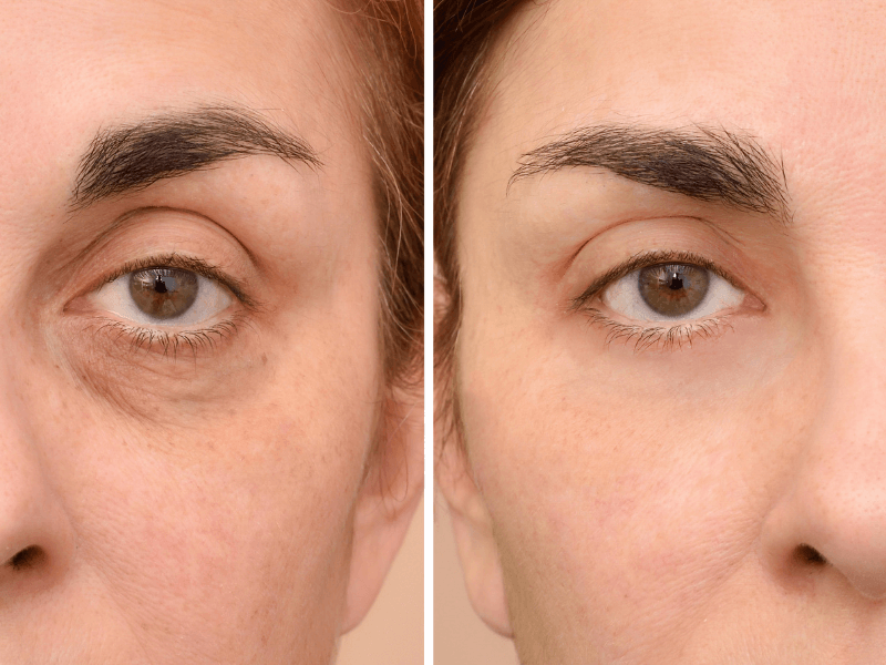 eliminacion ojeras valencia