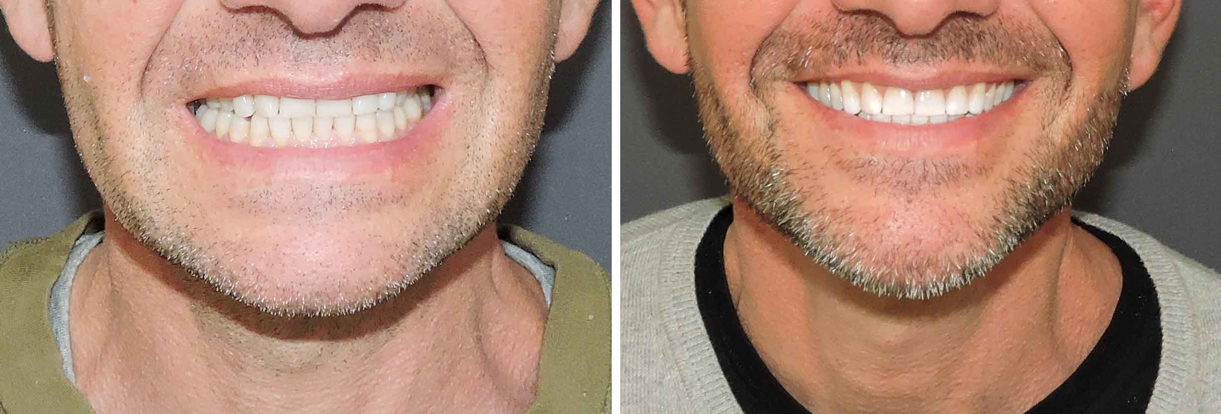 resultado blanqueamiento dental