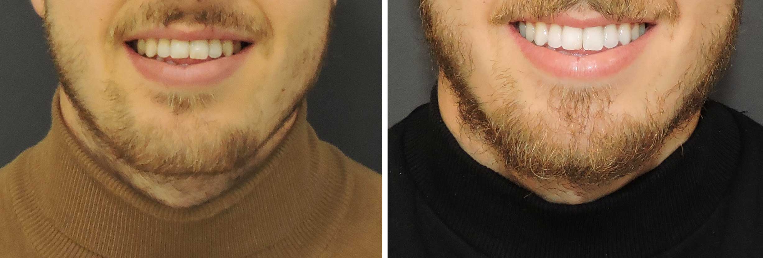 resultados blanqueamiento