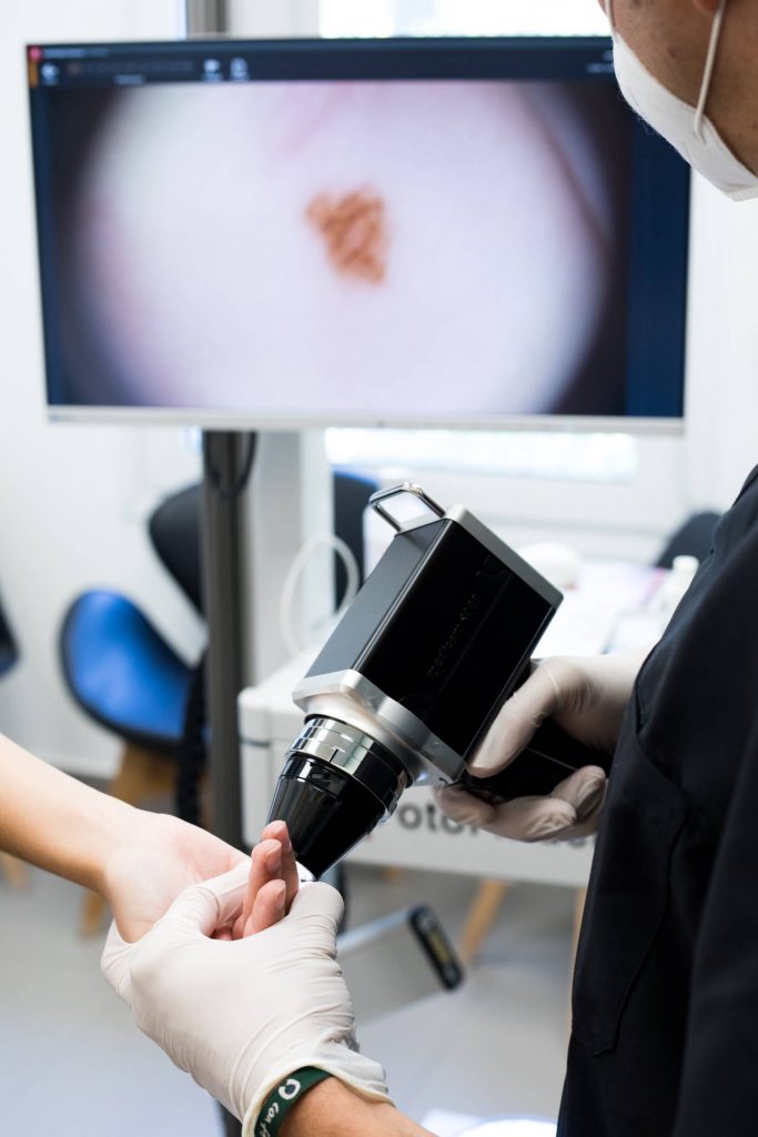 tratamiento lunares valencia