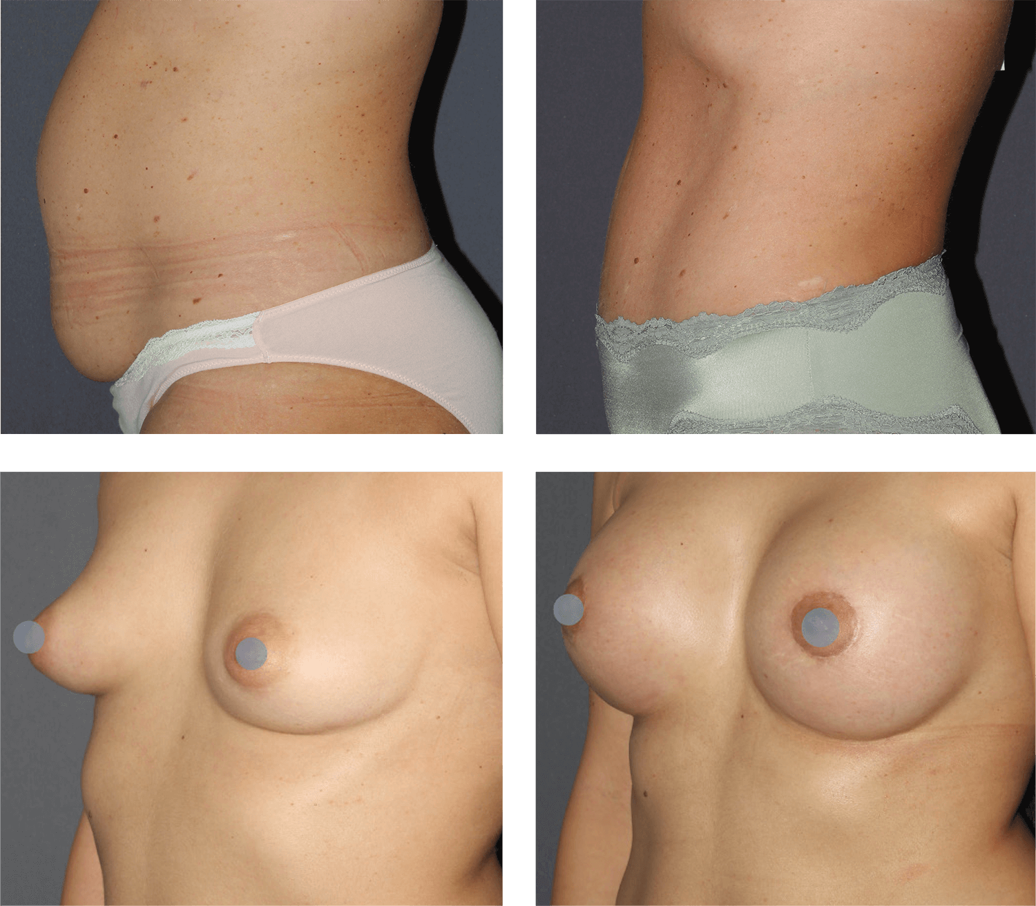 antes y ahora plástica