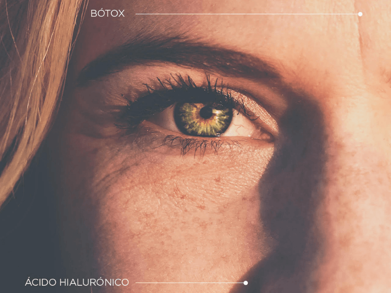 botox o acido hialuronico