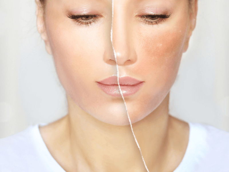 manchas verano eliminar