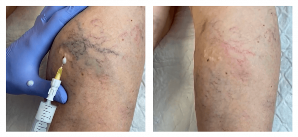 varices-ejemplos varices-ejemplos