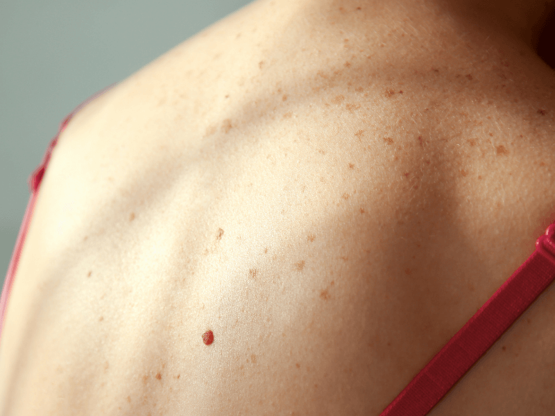 como prevenir el cancer de. piel