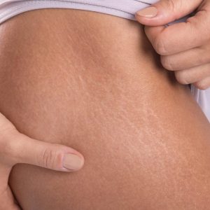 eliminar estrias rapido