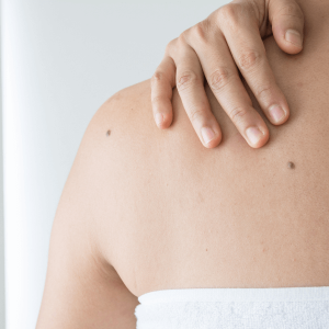 melanoma tratamientos