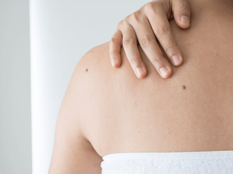 melanoma tratamientos