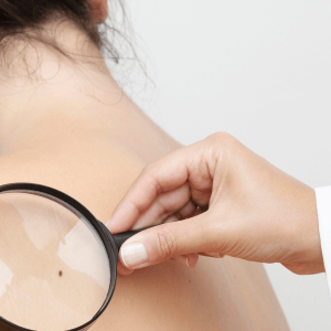 CANCER DE PIEL TODO LO QUE HAY QUE SABER