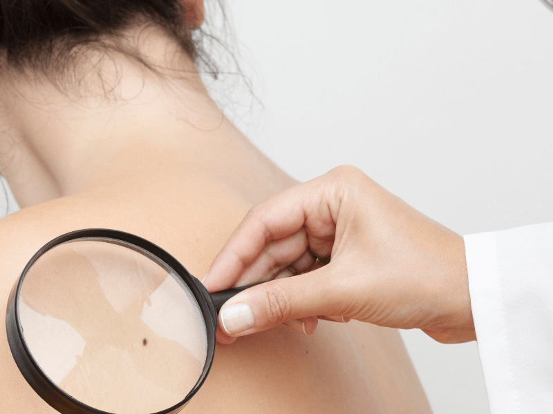 CANCER DE PIEL TODO LO QUE HAY QUE SABER